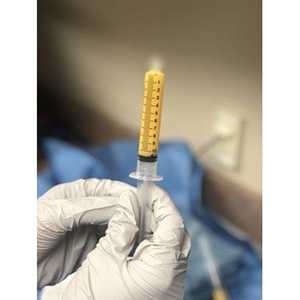 Microfat in syringe