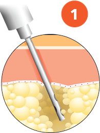 Bild der Lipoaspiration als erster Schritt eines Mikrofettverfahrens