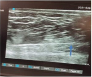 View of hypoechogenic ﬂuid in deep layer of fat - Ultrasound-guided abdominal lipoaspiration.